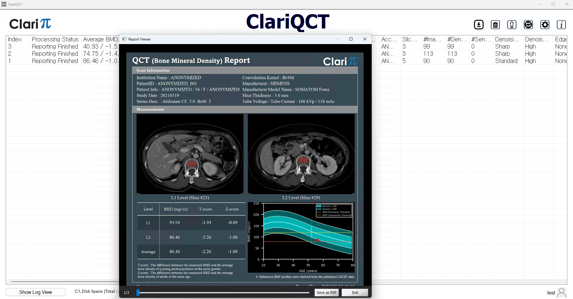 AI기반 CT영상 골밀도 분석 솔루션 (ClariQCT)